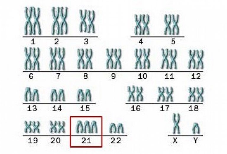 Карта фенотипа синдром дауна