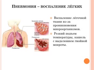 Пневмония