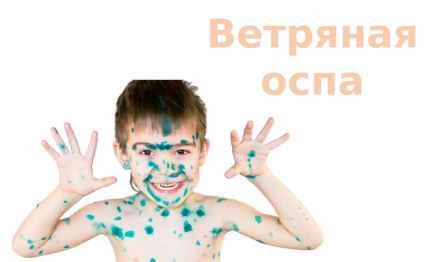 Ветряная оспа: что нужно знать каждому